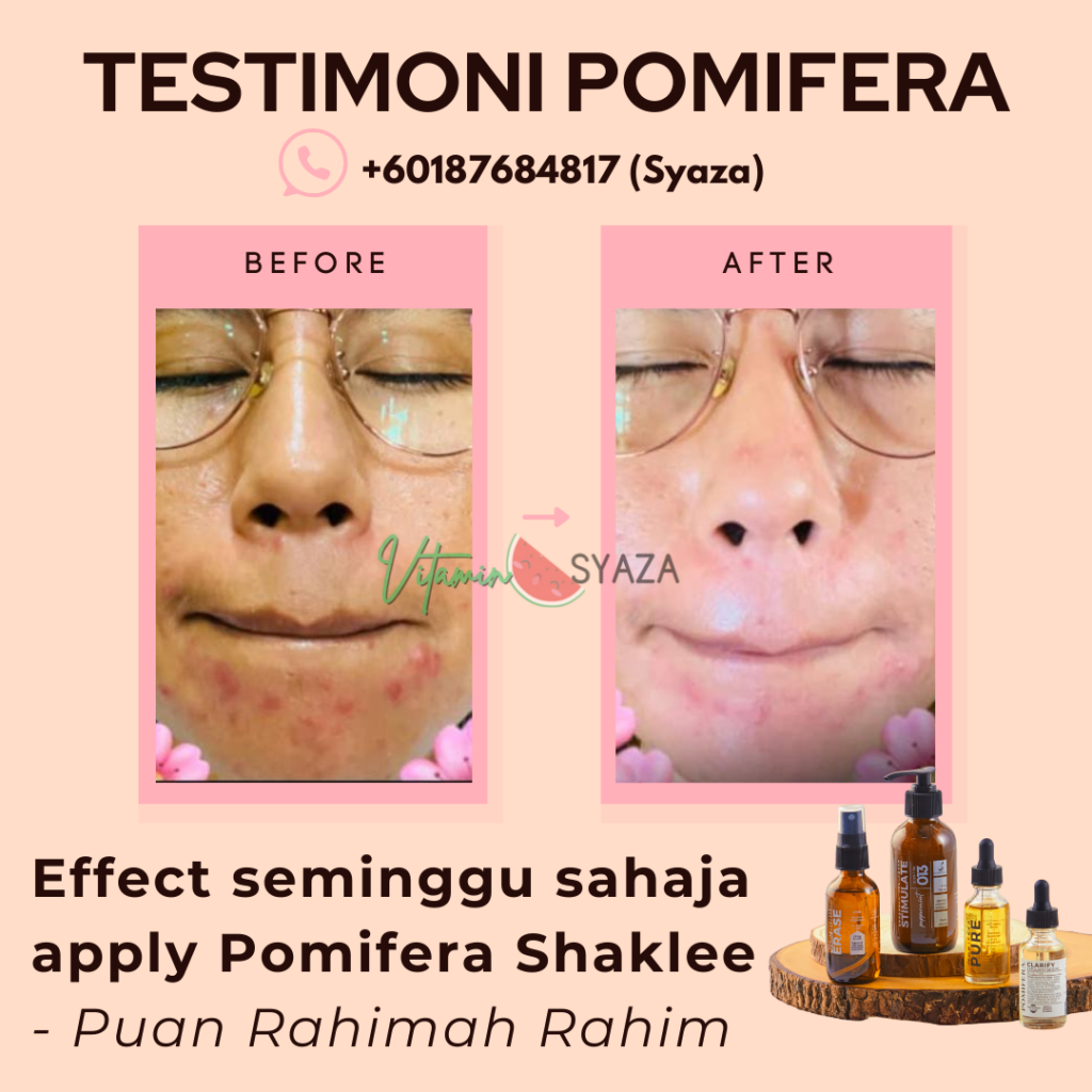 Testimoni Pomifera Shaklee Hasil Kesan Effect Lepas Guna Seminggu Untuk Masalah Kulit Jerawat 1